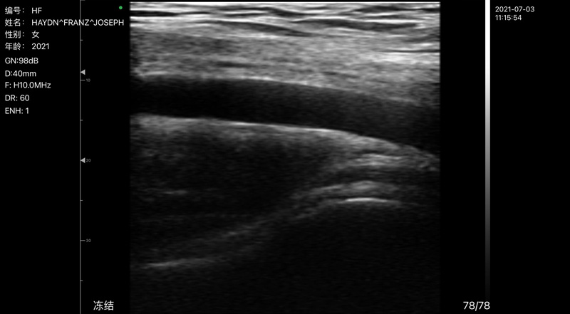 Wireless Ultrasound for Arteria ascellare C