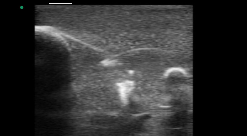 Wireless Ultrasound for Allenamento per la biopsia del seno