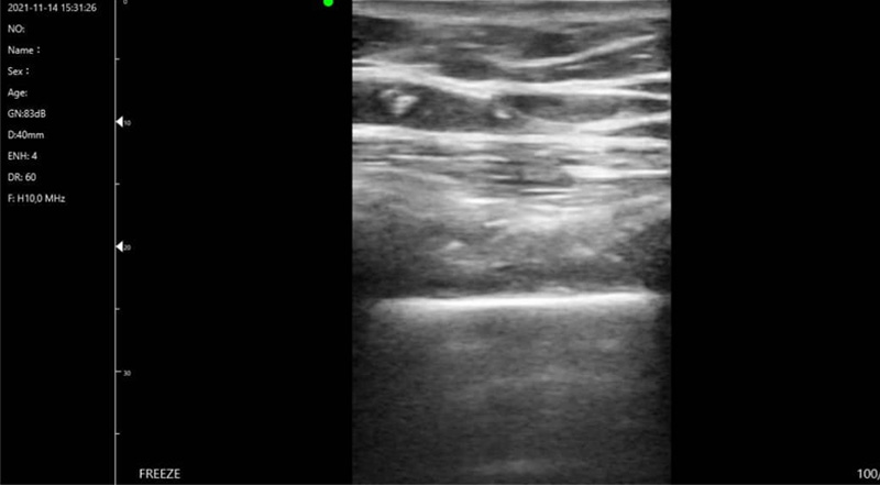 Wireless Ultrasound for C10T polmone