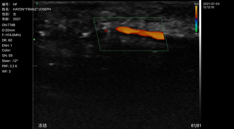 Wireless Ultrasound for Arteria delle dita
