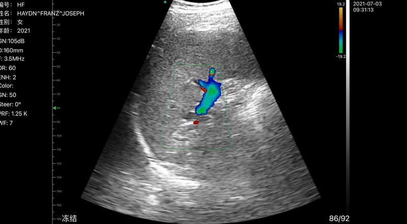 Wireless Ultrasound for Milza