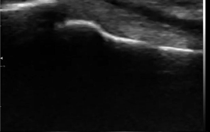 Tendine Flexor a dito con sonda ad ultrasuoni lineare curva