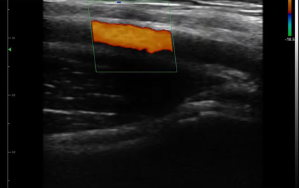 Array lineare sonda ultrasuoni ascellare arteria C