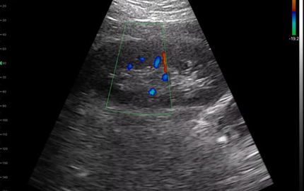 Scansione ad ultrasuoni per tutto il corpo rene C